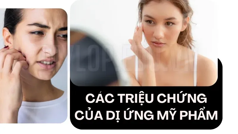 Làm gì khi da bị dị ứng mỹ phẩm? Mẹo giúp phục hồi nhanh nhất 5