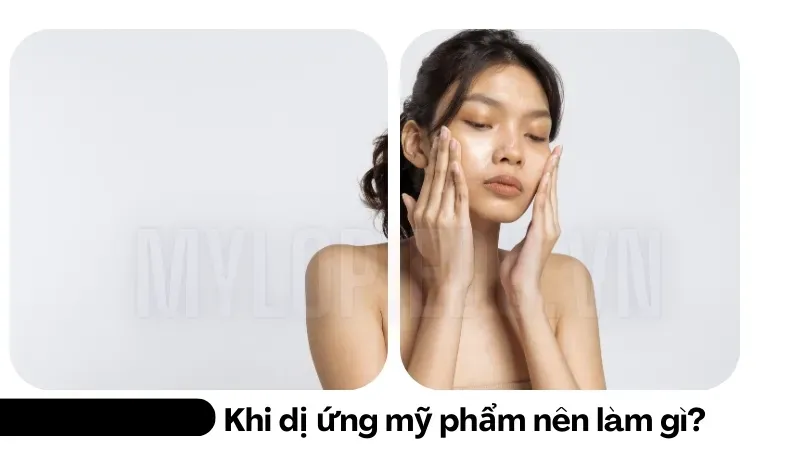 Làm gì khi da bị dị ứng mỹ phẩm? Mẹo giúp phục hồi nhanh nhất 4