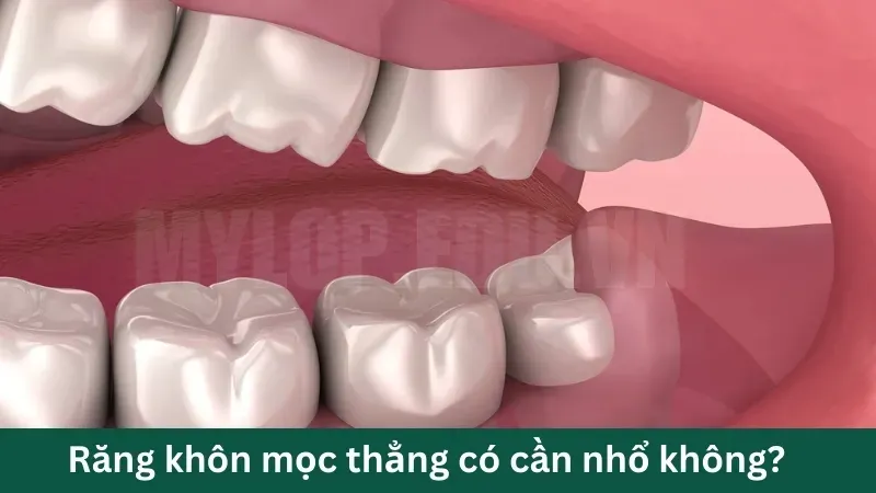 Cách kiểm tra răng khôn mọc thẳng hay lệch tại nhà 2