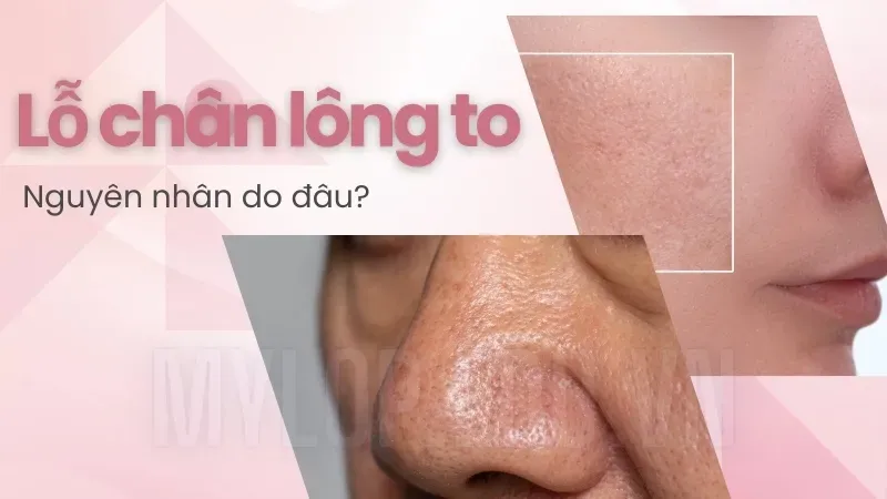 Lỗ chân lông to nên làm gì? Các bước skincare hiệu quả dành cho bạn 7