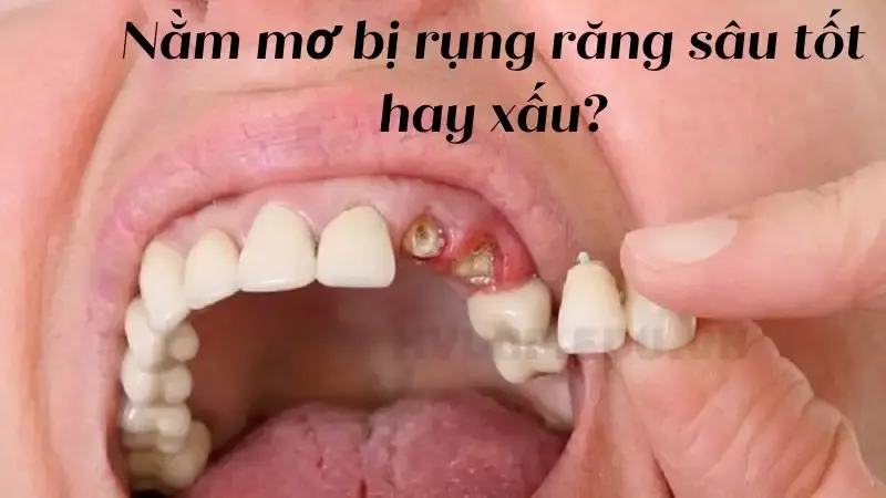 Nằm mơ bị rụng răng hàm trên có ý nghĩa gì?