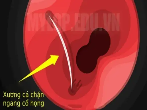 Bị hóc xương cá phải làm thế nào? Lời khuyên từ chuyên gia