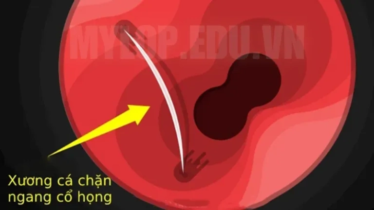 Bị hóc xương cá phải làm thế nào? Lời khuyên từ chuyên gia