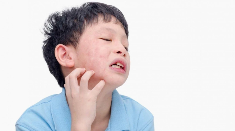 Bí quyết chữa quai bị bằng mẹo dân gian hiệu quả và an toàn