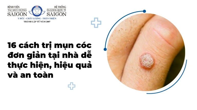 Bí quyết Trị Mụn Cóc Dân Gian: Hiệu quả, An toàn và Đơn giản