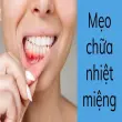 Mẹo chữa nhiệt miệng giúp hết đau rát chỉ sau một đêm