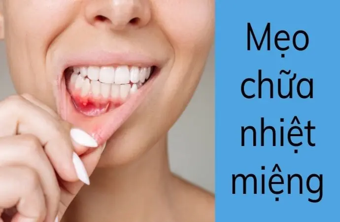 Mẹo chữa nhiệt miệng giúp hết đau rát chỉ sau một đêm