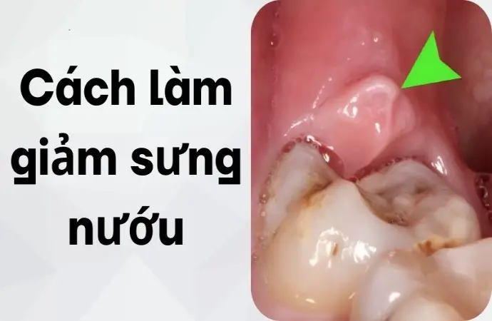 Cách làm giảm sưng nướu từ nguyên liệu quen thuộc sẵn có