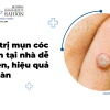 Bí quyết Trị Mụn Cóc Dân Gian: Hiệu quả, An toàn và Đơn giản