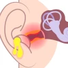 Bí quyết trị viêm tai giữa ở người lớn hiệu quả và an toàn