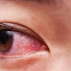 Mẹo Chữa Đau Mắt Đỏ Nhanh Nhất: Giải Pháp Tại Nhà Hiệu Quả