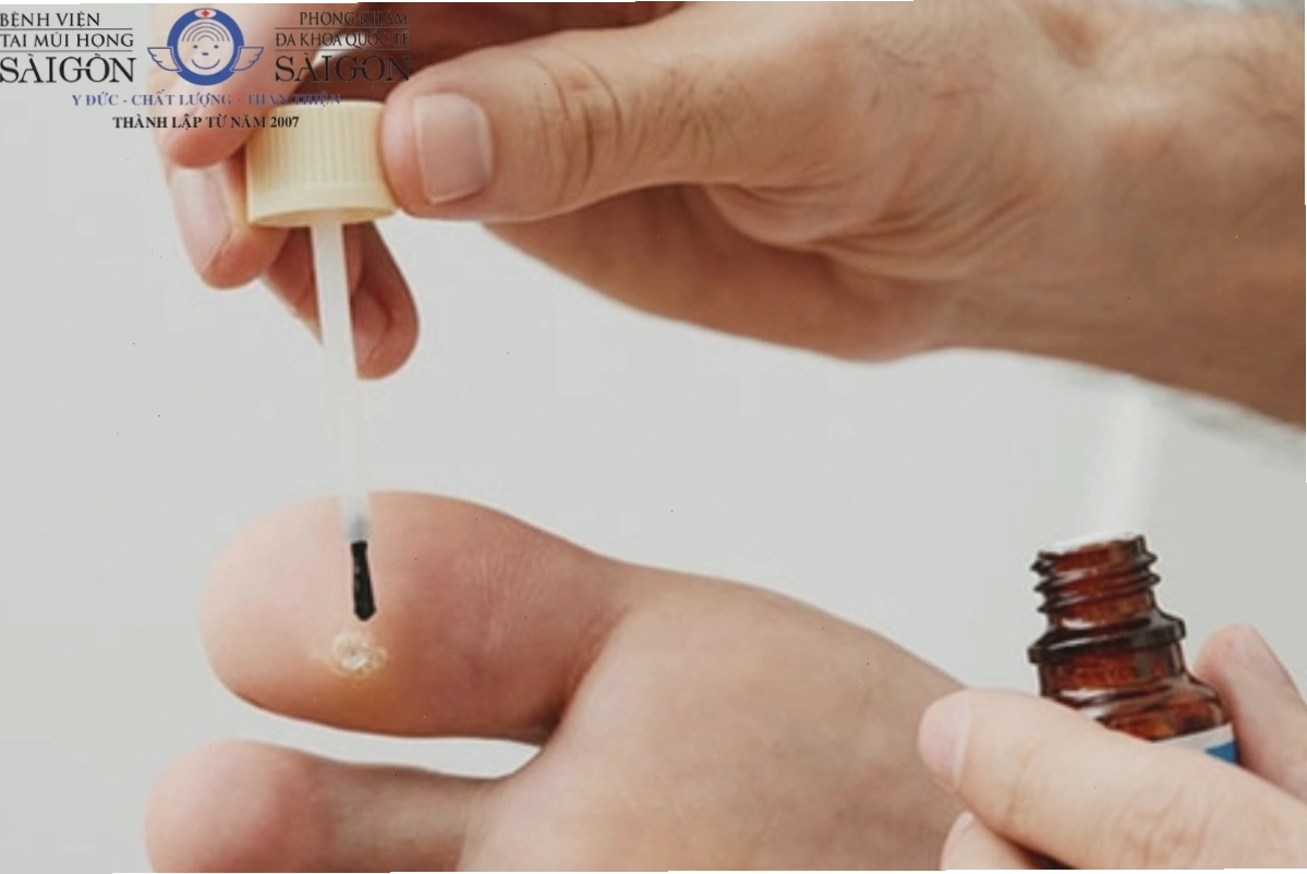 Bác sĩ đang tư vấn phương pháp trị mụn cóc