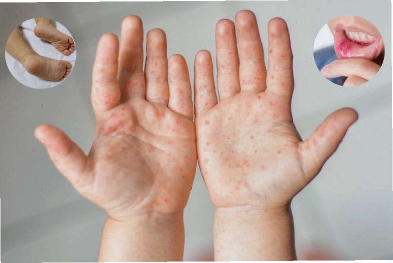 Biểu hiện ban đỏ và mụn nước đặc trưng của bệnh chân tay miệng trên da trẻ