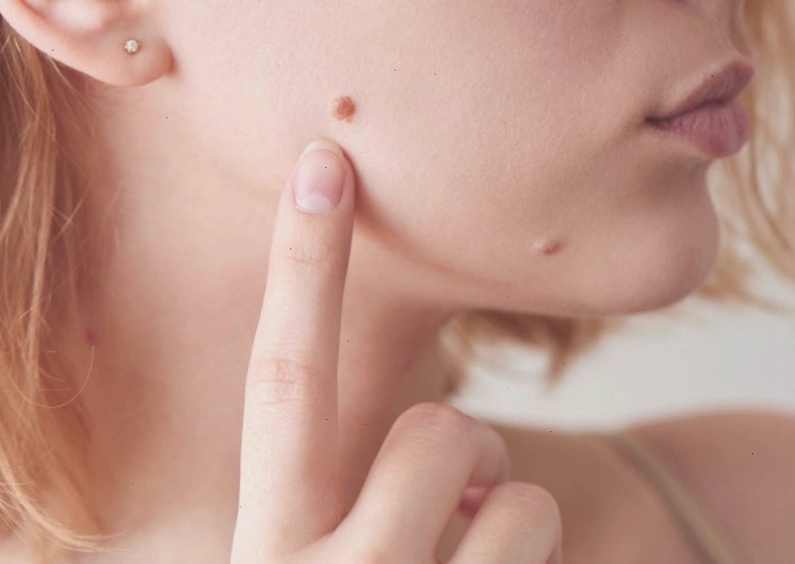 Bôi nước cốt chanh lên mụn cóc