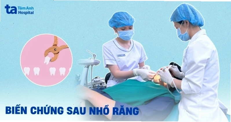 Các biến chứng có thể xảy ra sau khi nhổ răng và cách phòng ngừa
