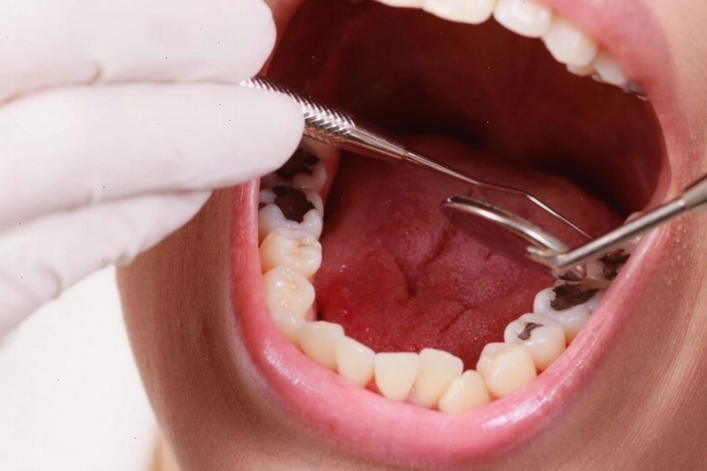 Cần đi khám nha sĩ để tìm nguyên nhân và điều trị nhức răng