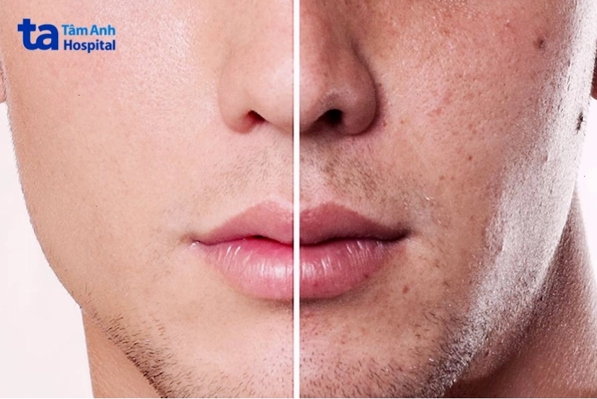 Hình ảnh so sánh trước và sau khi triệt râu
