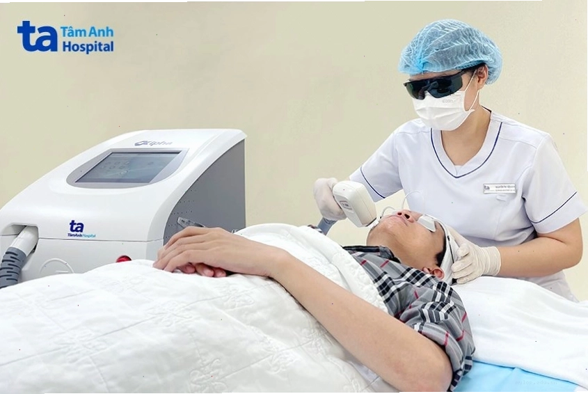 Kỹ thuật viên đang triệt râu cho khách hàng bằng công nghệ điện phân