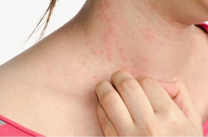 Mẩn ngứa vùng cổ do dị ứng thời tiết