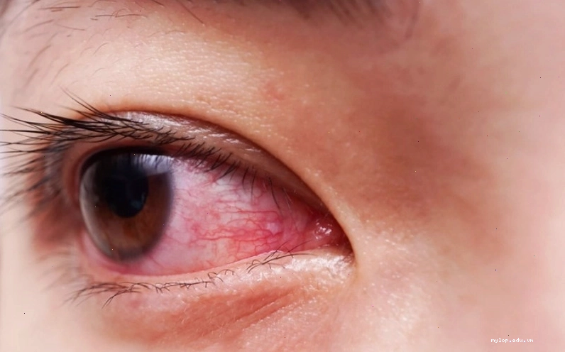 Mắt bị đỏ do viêm kết mạc là dấu hiệu của đau mắt đỏ