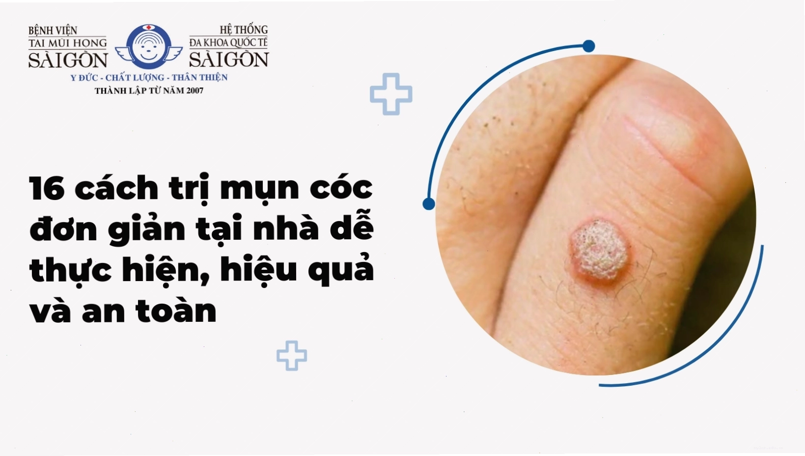 Miếng dán băng dính cá nhân trị mụn cóc