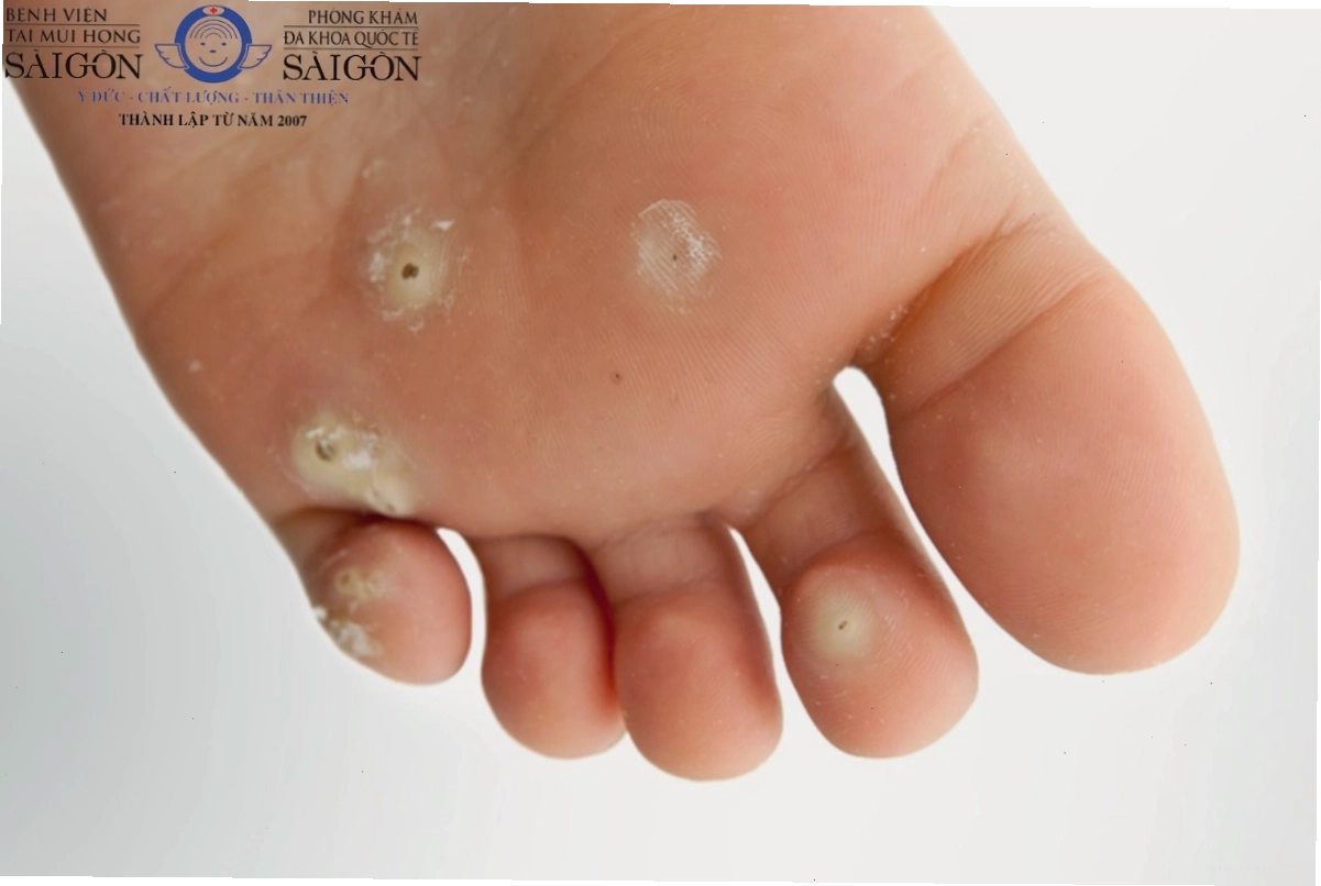Mụn cóc xuất hiện nhiều và cần thăm khám bác sĩ