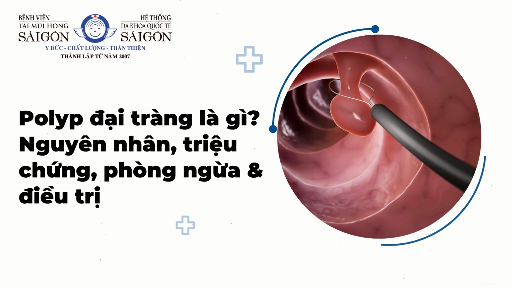 Polyp đại tràng là một trong những biến chứng có thể xảy ra nếu táo bón kéo dài