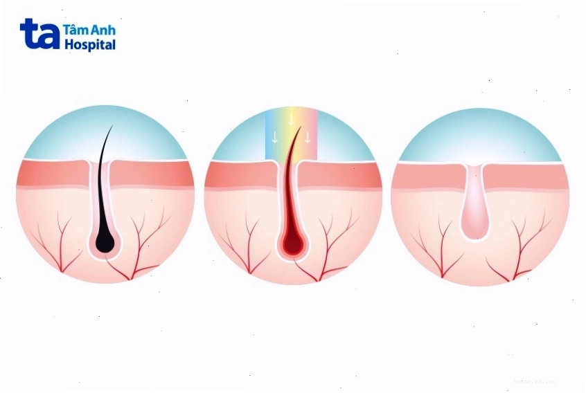 Quy trình triệt râu chuẩn y khoa bằng laser