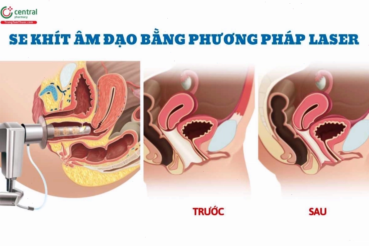 Trẻ hóa và làm hồng vùng kín bằng công nghệ laser