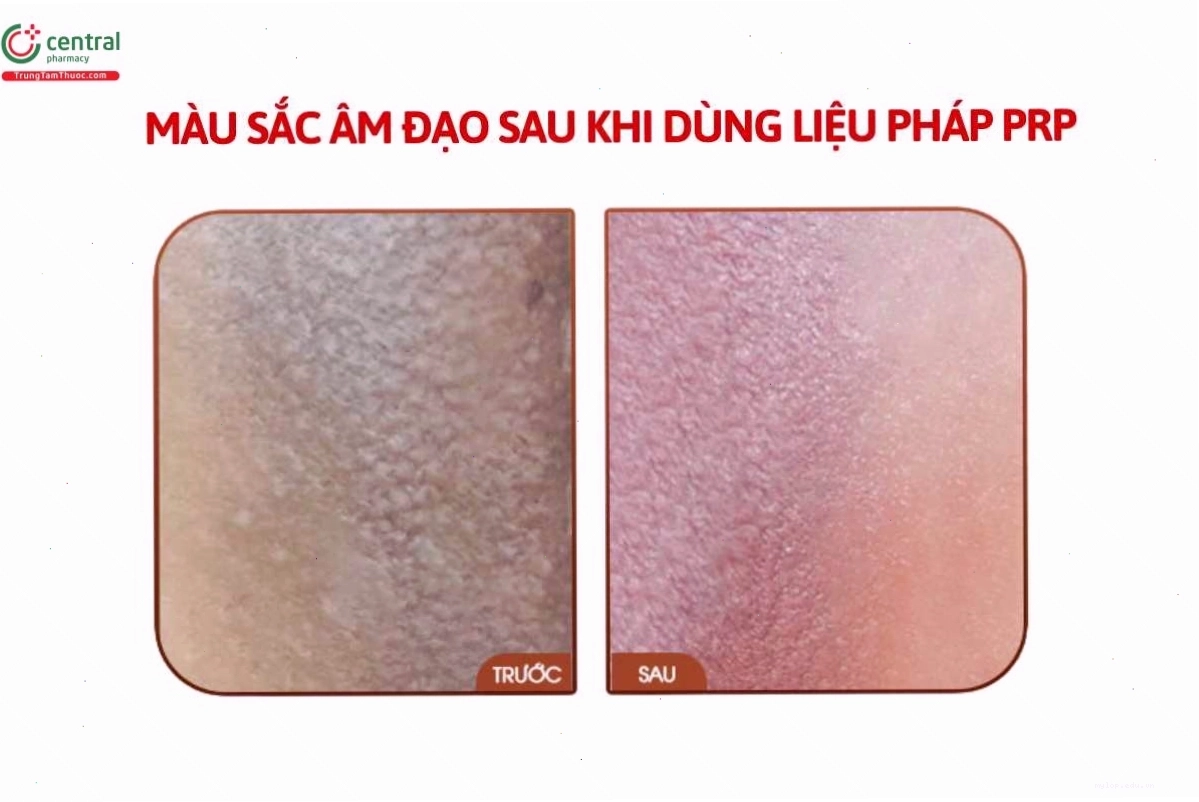 Trị thâm cô bé bằng liệu pháp PRP