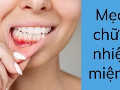 Mẹo chữa nhiệt miệng giúp hết đau rát chỉ sau một đêm