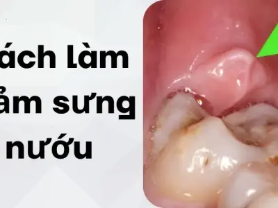 Cách làm giảm sưng nướu từ nguyên liệu quen thuộc sẵn có