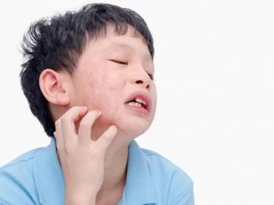 Bí quyết chữa quai bị bằng mẹo dân gian hiệu quả và an toàn