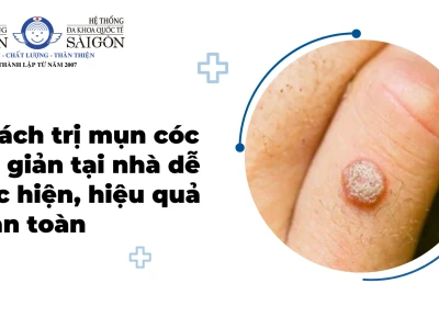 Bí quyết Trị Mụn Cóc Dân Gian: Hiệu quả, An toàn và Đơn giản