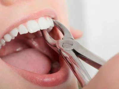 Các Cách Cầm Máu Sau Khi Nhổ Răng Hiệu Quả