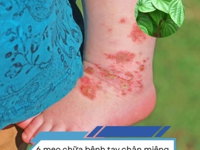 Mẹo dân gian chữa bệnh chân tay miệng hiệu quả tại nhà